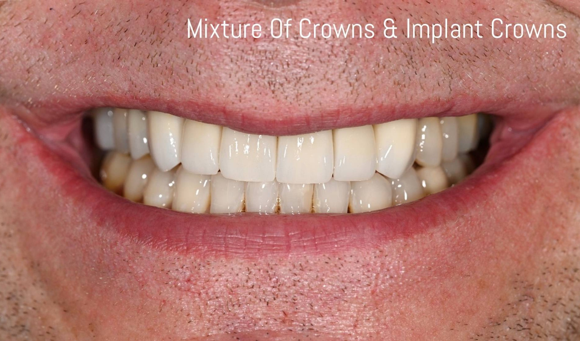 Crowns Before & After Image